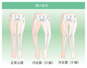 変形性膝関節症における臨床的評価法 - 整形外科医師による関節